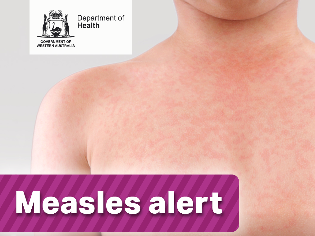 Measles alert